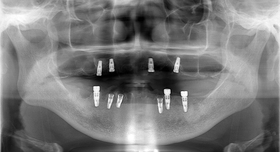 インプラント実施後